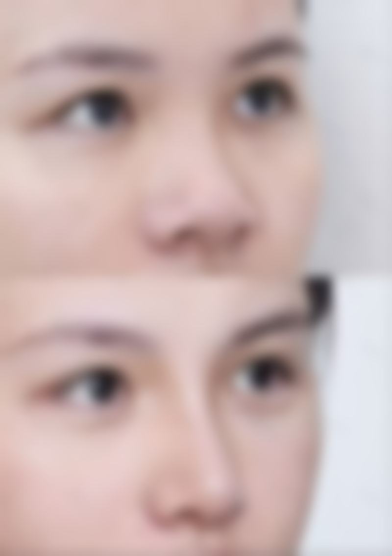 45岁抗衰：热玛吉与超声 刀的术后护理