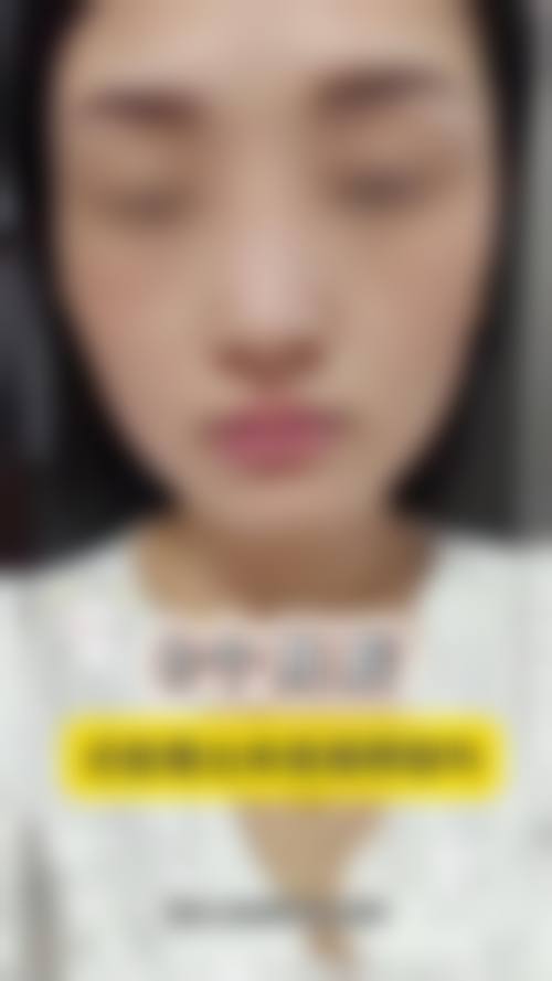 马鹏飞牙齿种植实例