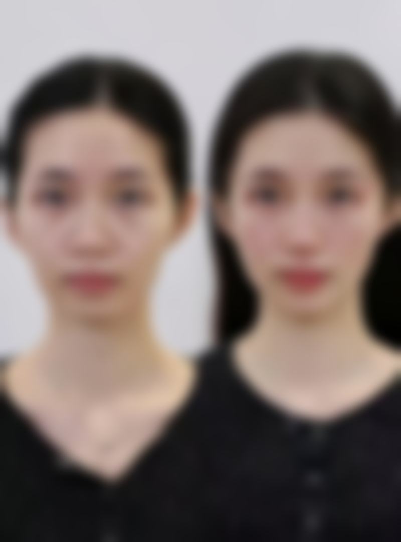 六、厦门大麦微针植发价格表：（仅供参考）