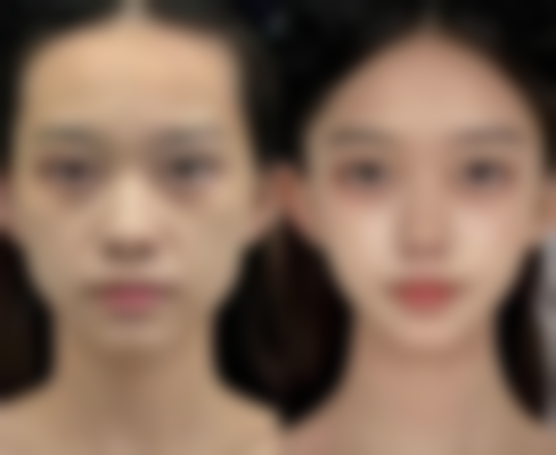 李秉夏眼部整形实例