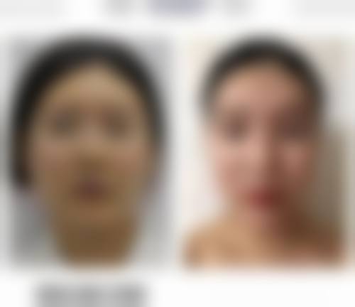 蒋克锋牙齿美容修复实例