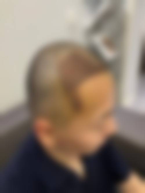 崔义泽植发水平怎么样可靠吗？