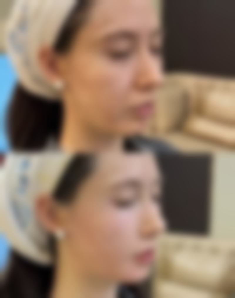 四、南阳熙沐媛整形医院实例