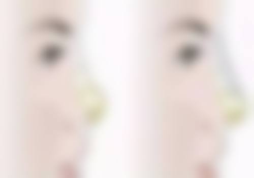 五、许昌丽娜整形医院实例