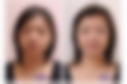 线提升去眼袋有啥优势？