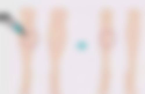 玻尿酸注射除皱效果佳？不仅填平静态纹，联合治疗还能搞定动态纹！ 