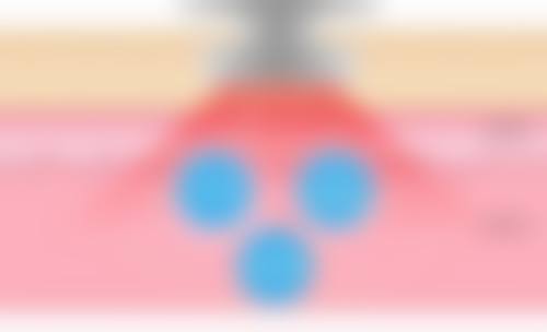 胸前痘痘留疤疙瘩莫急！医院开展项目多满足需求