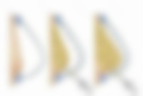 术后护理：保护自体脂肪隆胸成效