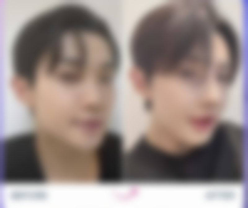 肋软骨隆鼻效果究竟如何？自然风格呈现、个性化定制及快速恢复成显著亮点 