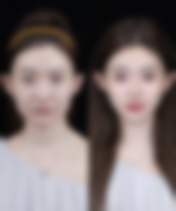 五、广州美携整形医院实例