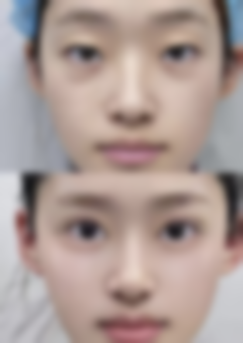 双眼皮显老之谜大揭秘：手术操作有门道