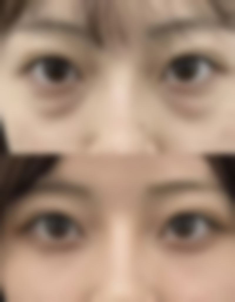 割双眼皮能变得更美？独特美眼等你拥有