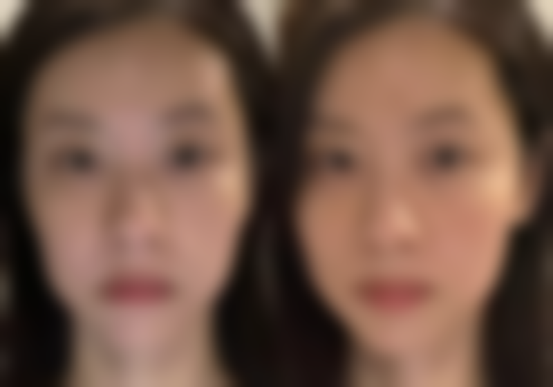 如何延长线提升去眼袋成效的秘诀？