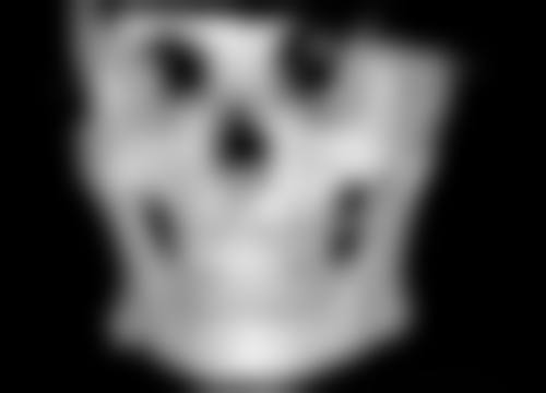 硅胶隆鼻完全修复：3 - 6 个月容貌巅峰重现