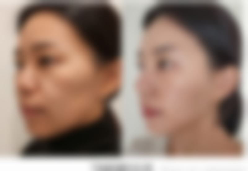 破解眼袋脂肪消除之谜：选择适合的治疗方案