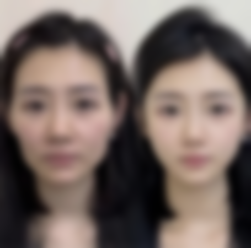 专精医院助力双眼皮修复