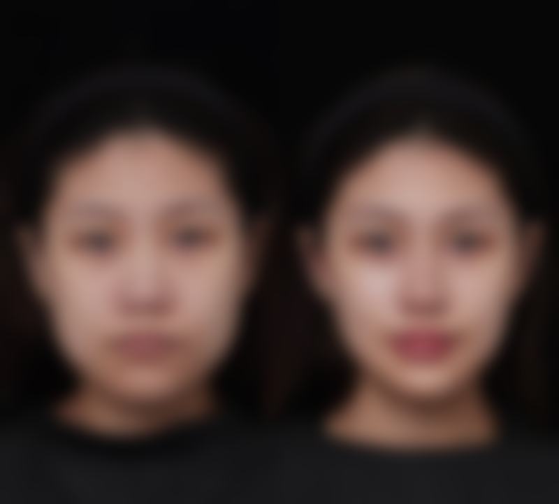 效率高修复自然美眼？专精医生保驾护航