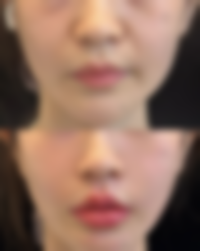 隆鼻之后何时能捏？成熟期的“适度轻捏”