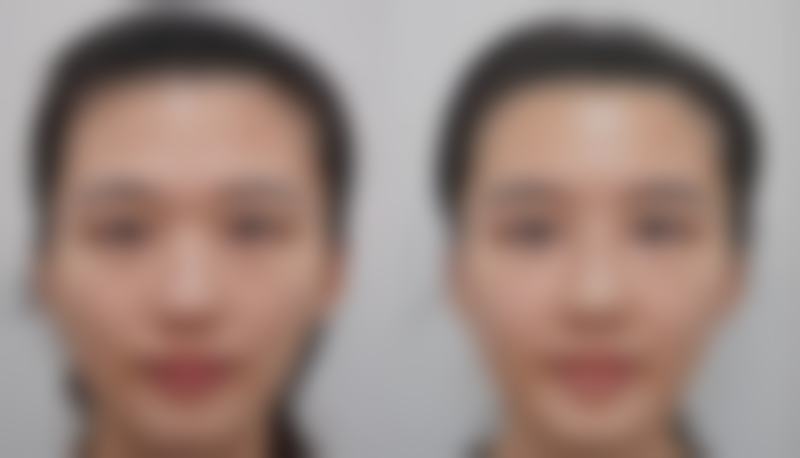 告别大眼袋小妙招之分阶处理——轻医美方向