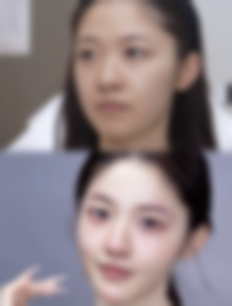 破解眼袋里脂肪消除之谜：多种医美方案，兼顾美观与效果的眼部焕颜秘诀 