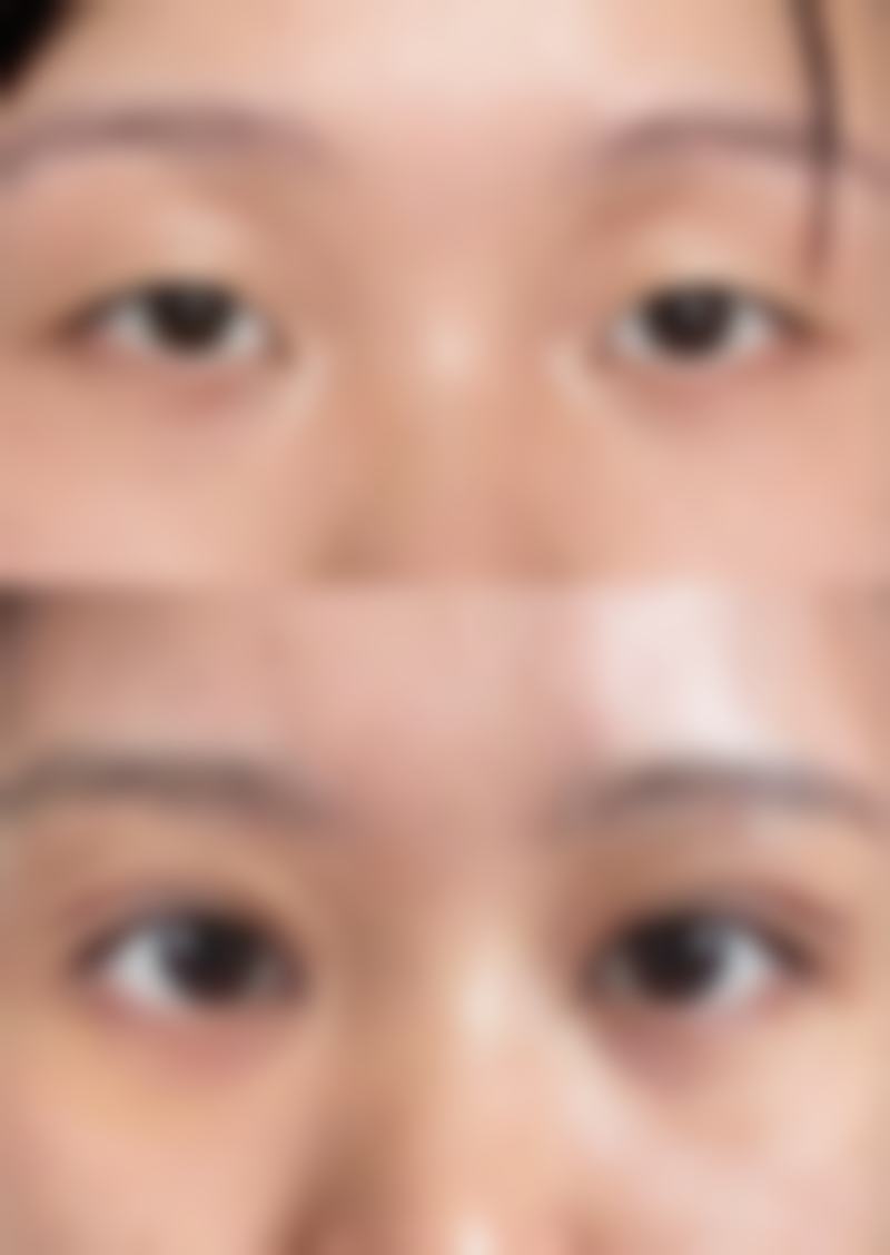 医院选择与疤痕修复