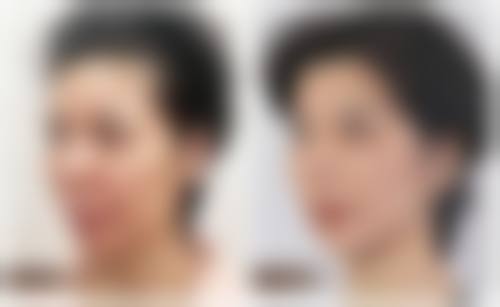 李戍波乳头乳晕缩小水平怎么样可靠吗？