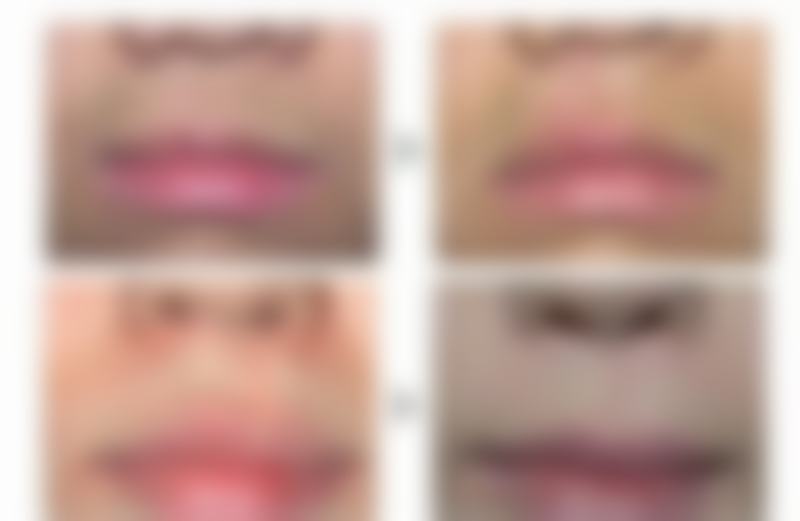 想完全消除眼袋？手术治疗是王道