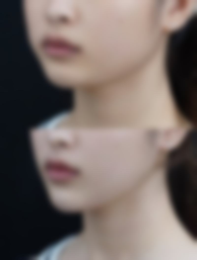 植入双眼皮能否恒久？推荐几家优质医美医院