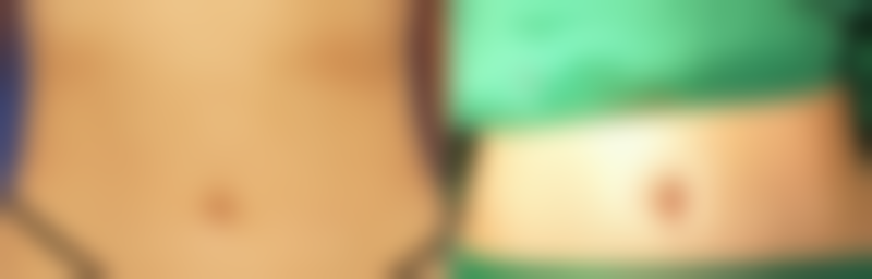 植入双眼皮能否恒久？术后保养延长成效秘诀