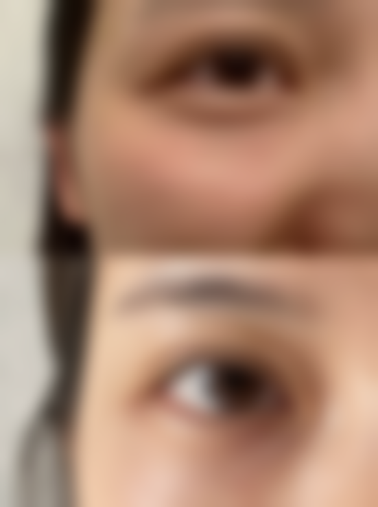 隆鼻后饮食通用原则，花生搭配有道