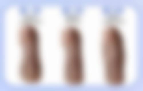 眼袋大并非缺乏蛋白质？正规医院优势多