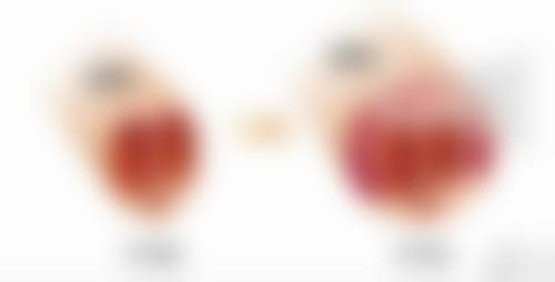 隆胸后能否给小孩喂奶？术前术后的准备和检查