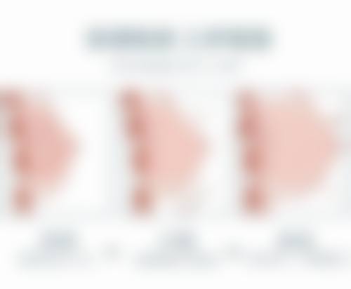 埋线双眼皮的医院选择和优势总结