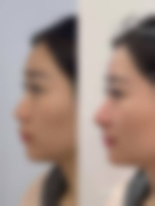 梁太鑫隆鼻水平怎么样可靠吗？