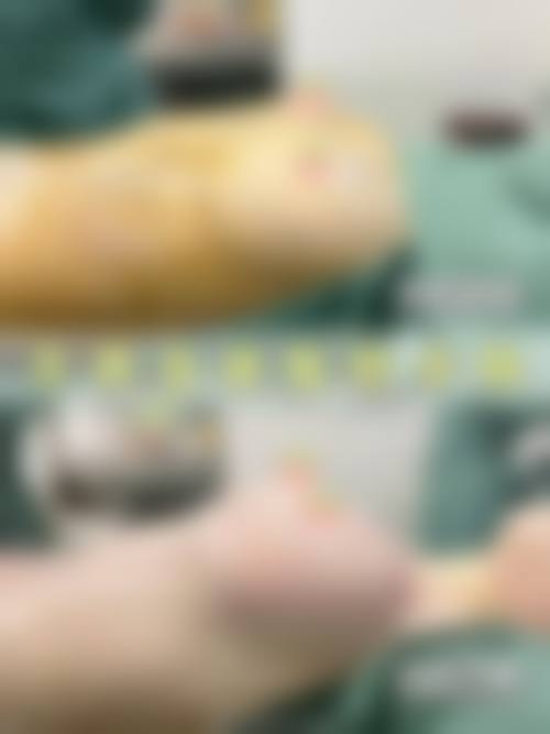 李戍波乳头乳晕缩小实例