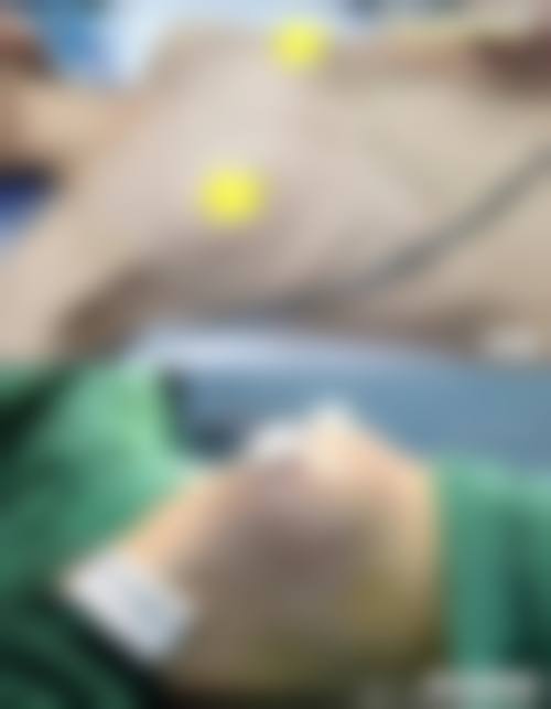 李戍波乳头乳晕缩小水平怎么样可靠吗？