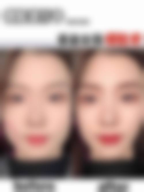 姜玉珀私人整形手术实例