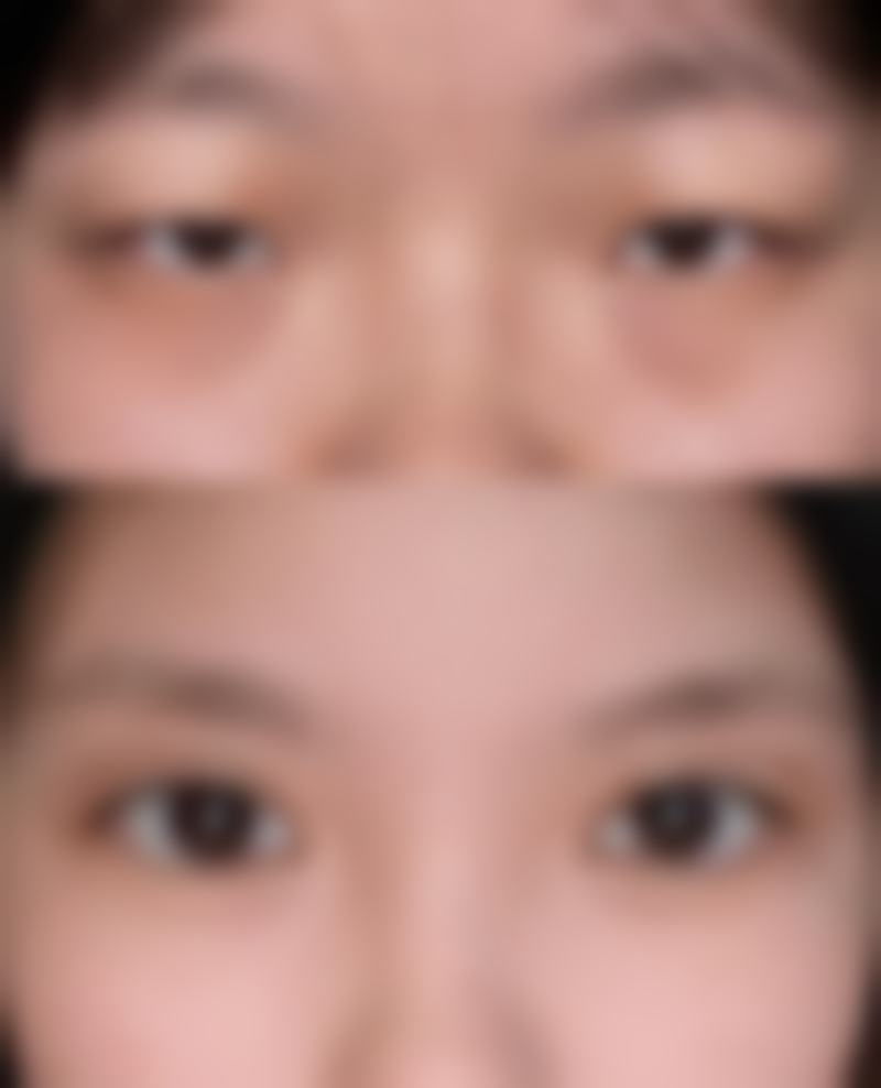 硅胶隆鼻能否终身不取出？选择正规医院是前提