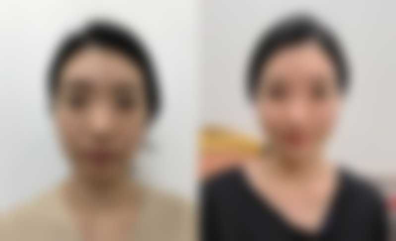 梁太鑫隆鼻实例