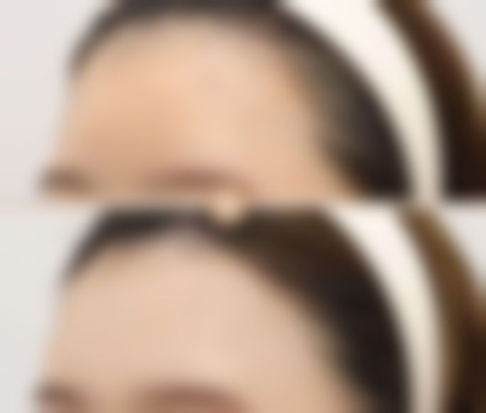 做阴道紧缩术后能否顺产？综合评估胎儿及阴道恢复状况，为顺产决策提供指引 