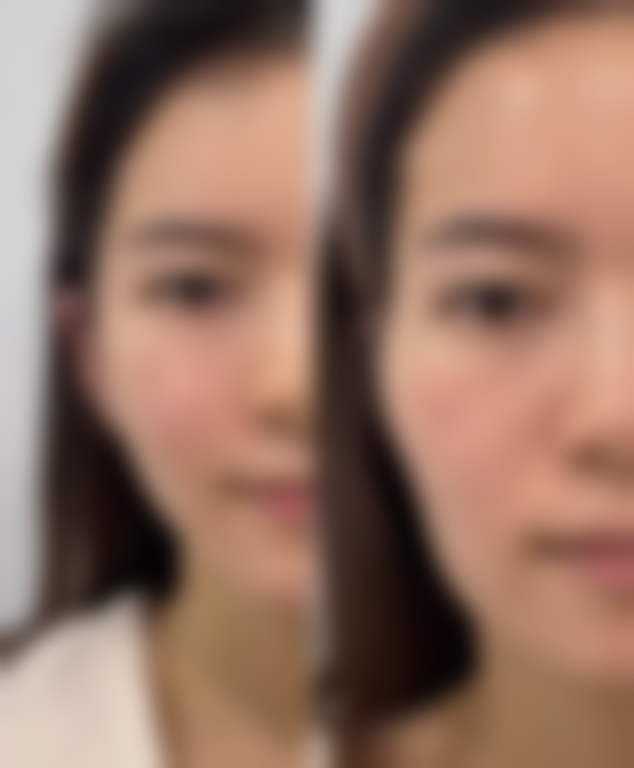 张东艳激光光美容实例