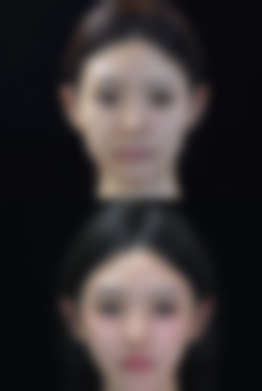 隆胸后能否给小孩喂奶？哺乳期间的注意事项