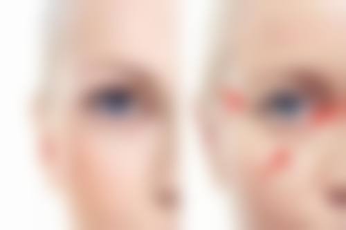 热油烫伤留疤不用愁！多方法综合治疗，专业医院助力疤痕显著淡化