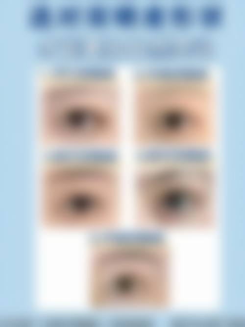 秦波澜眼部整形实例