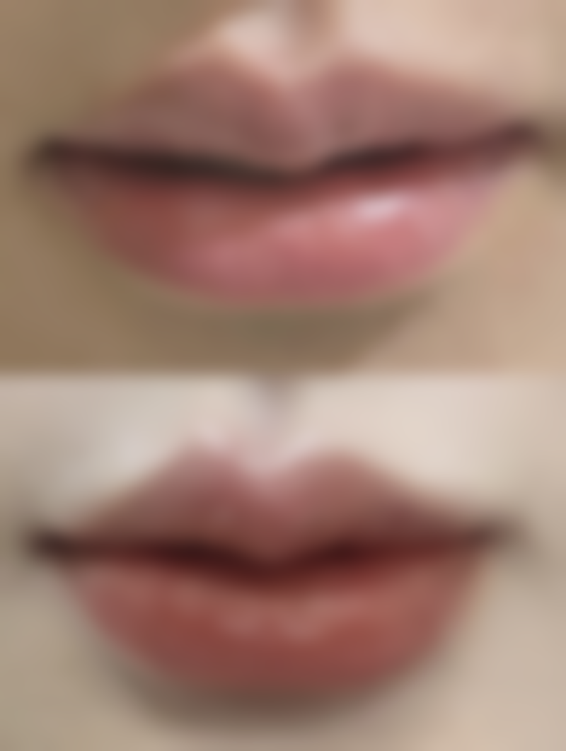 术后护理精心，双眼皮修复又快又好