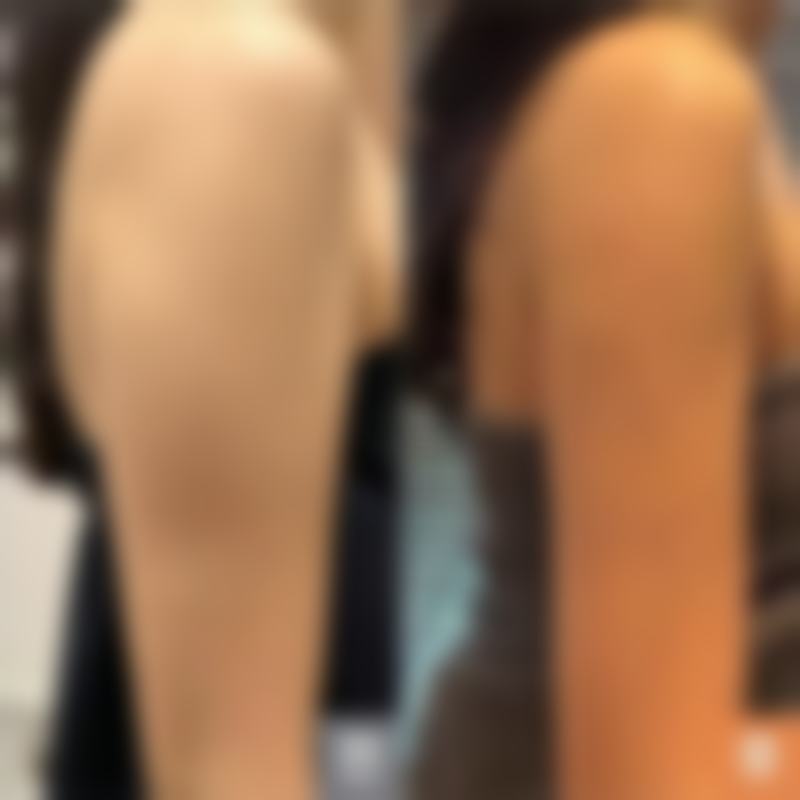 热油烫伤留疤别忧！专精医院显神通