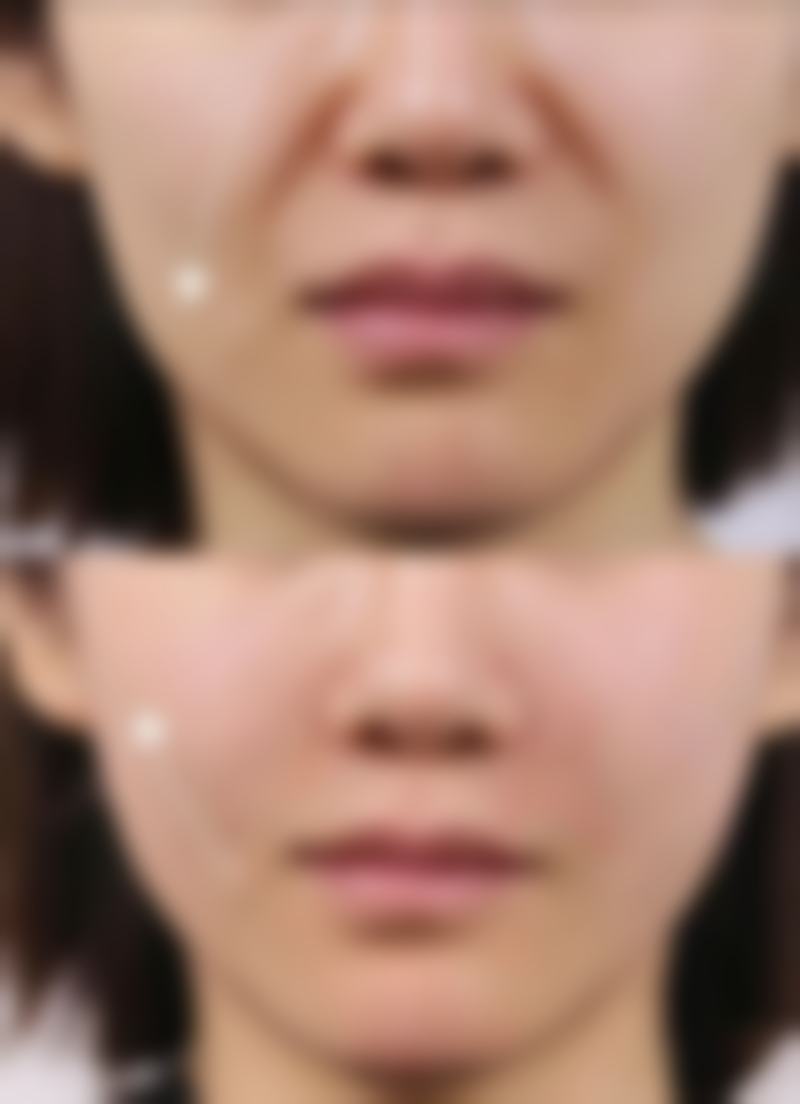 做完双眼皮一个月哭了，一般不影响效果，但需注意护理防肿胀和瘢痕增生 