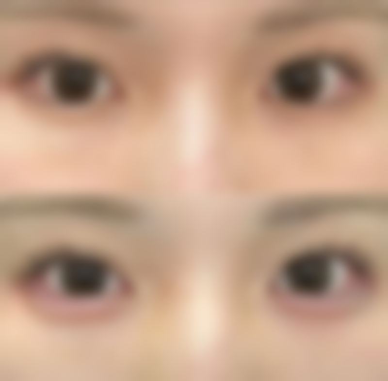 耳软骨隆鼻取出后修复指南：术后护理与修复时间表