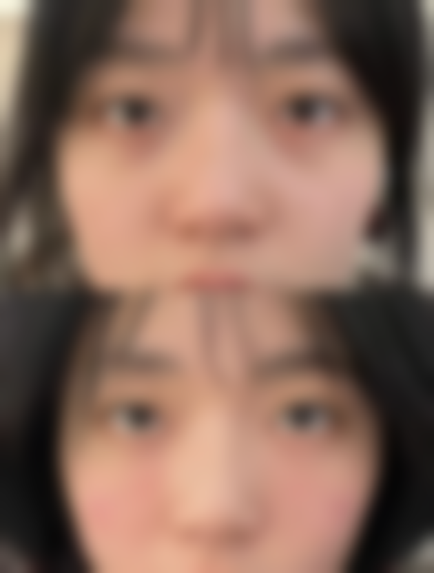 四、上海虹桥医院私密整形科实例