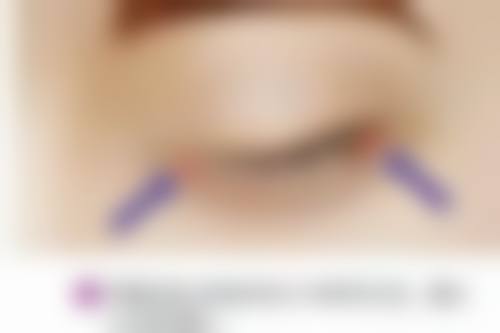 埋线与全切双眼皮怎么选？术后护理不能忘